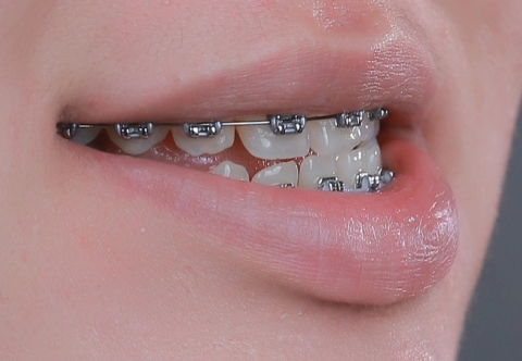 Niềng Răng Có Hết Móm Không? Có Phải Nhổ Răng Không